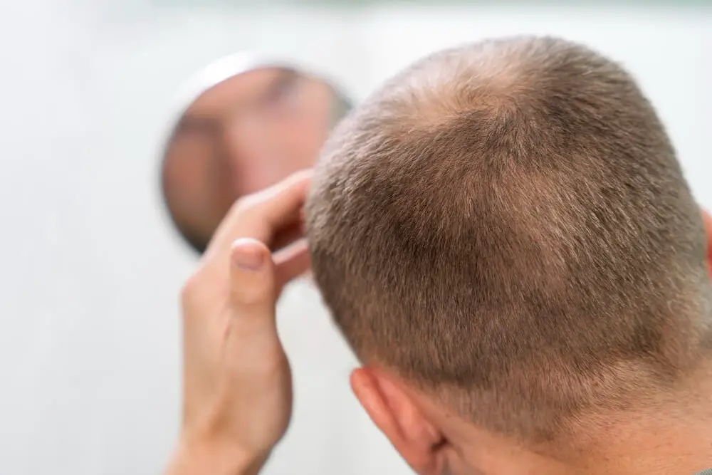 Dutasteride for Hair Loss Exploring Effectiveness, Side Effects, and Benefits